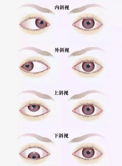 爱尔眼科：总爱偏头看，视力“一好一坏”？警惕斜视！
